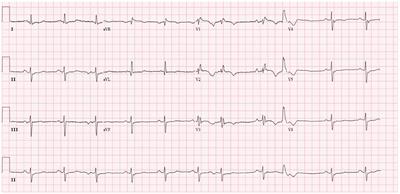 Case report: An unusual case of desmin myopathy associated with heart failure and arrhythmia